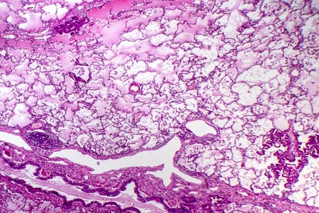 Adenokarsinoma insitu (AIS)
