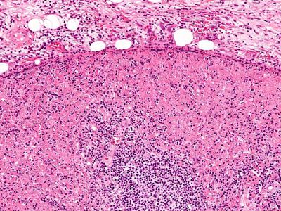 Gestasyonel trofoblastik hastalık (neoplazi)