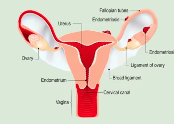 Endometriozis