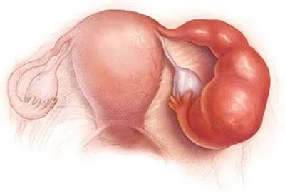 Üzüm gebeliği (mol / molar gebelik)