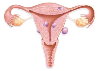 Miyom (myoma uteri)