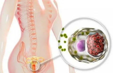 Çikolata kisti (endometrioma) ameliyatları