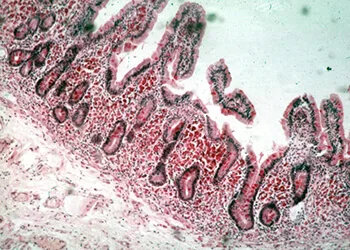 Adenomiyozis (adenomyoma)