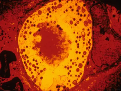 CIN (servikal intraepitelyal neoplazi)