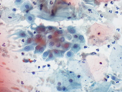 HSIL / LSIL / HPV+ ASCUS