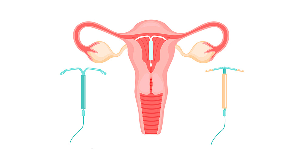 Hormonlu spiral takılması