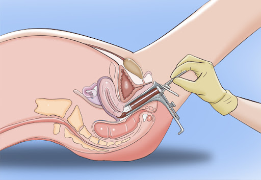 Pap smear